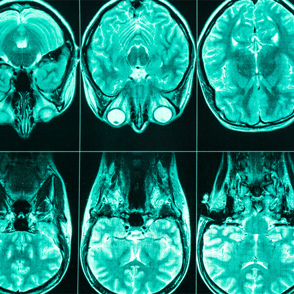 An MRI scan of a head